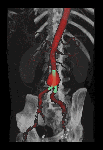 Endovascular Bifurcated Stent